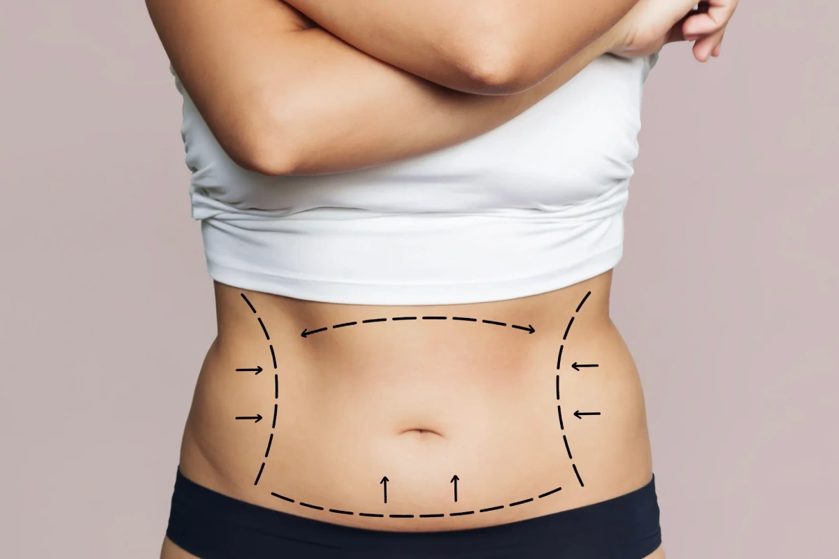 The Ultimate Guide to Care After Liposuction Surgery