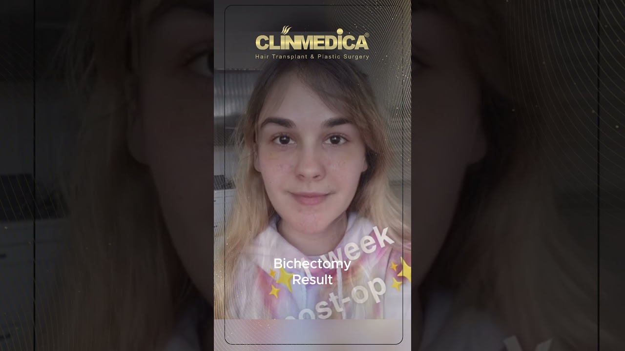 סרטון של ClinMedica: מטופלת מול המצלמה שבוע אחרי הניתוח, עם הכיתוב Bichectomy Result
