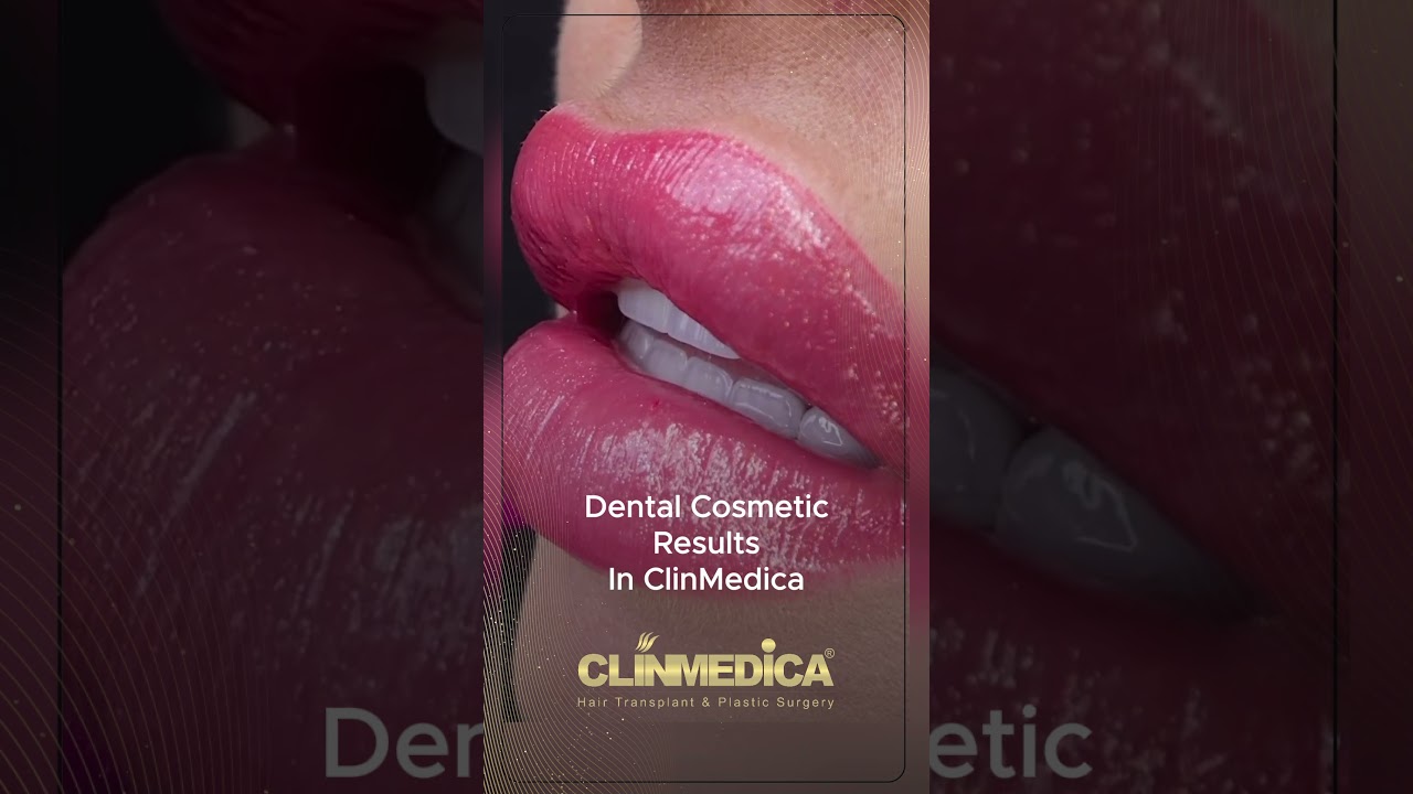 صورة مصغّرة لفيديو تظهر فيها شفاه لامعة مفتوحة على أسنان علوية بيضاء، بعنوان Dental Cosmetic Results In ClinMedica