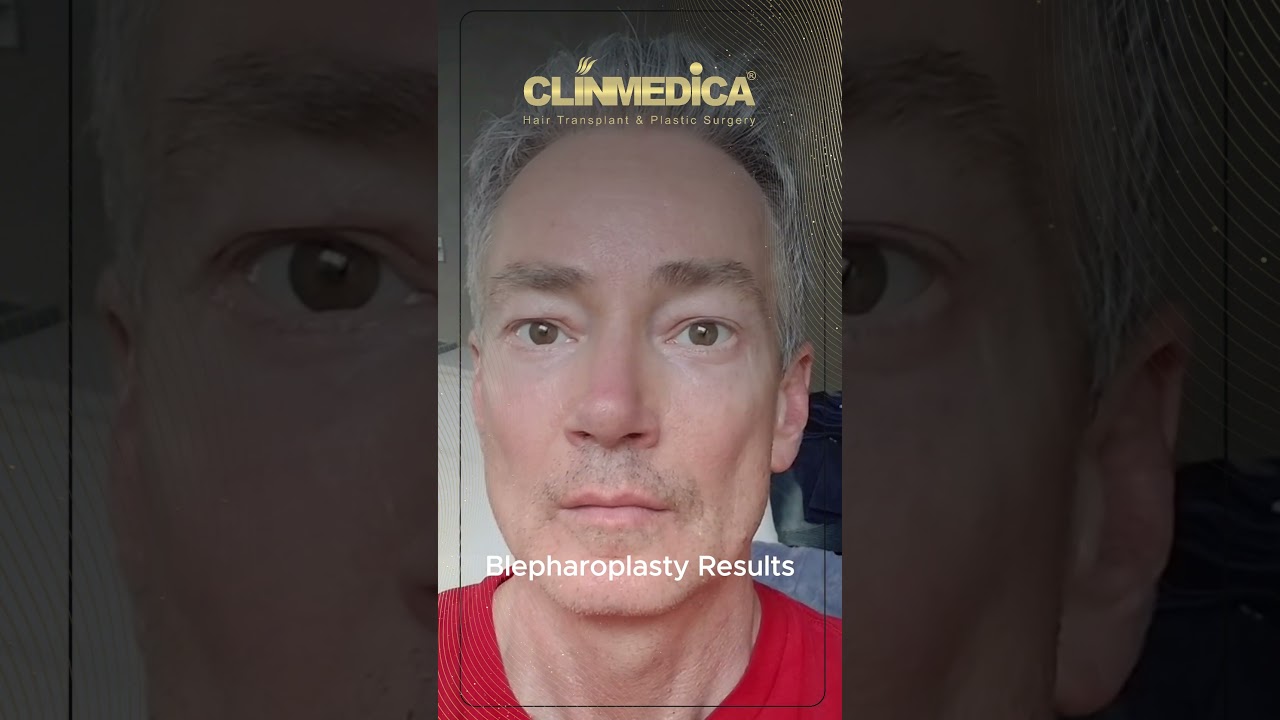 لقطة من فيديو ClinMedica لرجل ينظر إلى الكاميرا، مع تعليق على الشاشة: Blepharoplasty Results